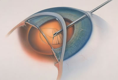 Cataract or cataract disease 